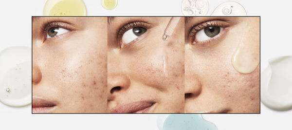 Acne-Free 2023: Top Skincare Treatment for Clearer, Glowing Skin